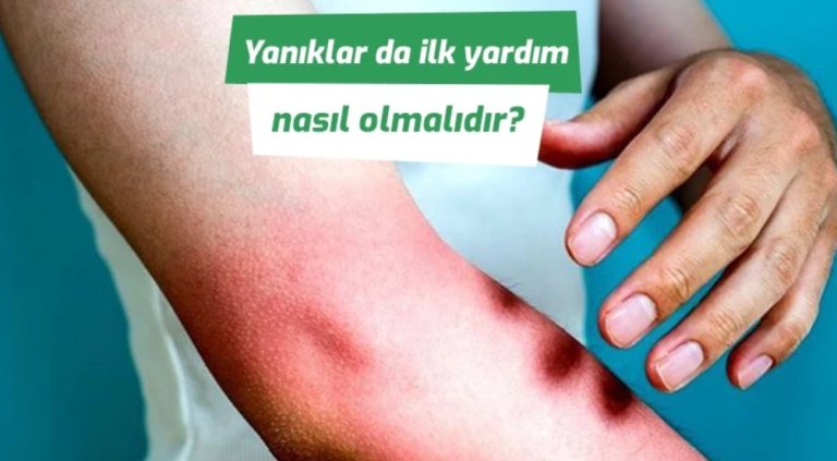 yanıklarda ilk yardım
